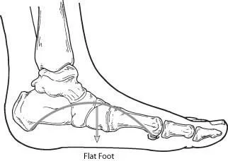 Flatfoot Flatfoot